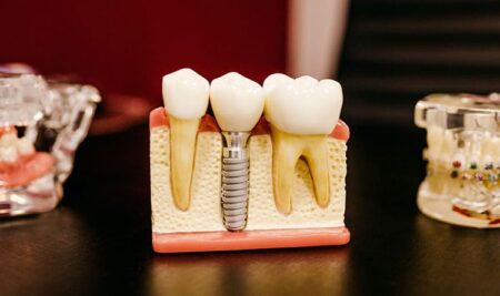 La importancia de la implantología oral en la odontología moderna