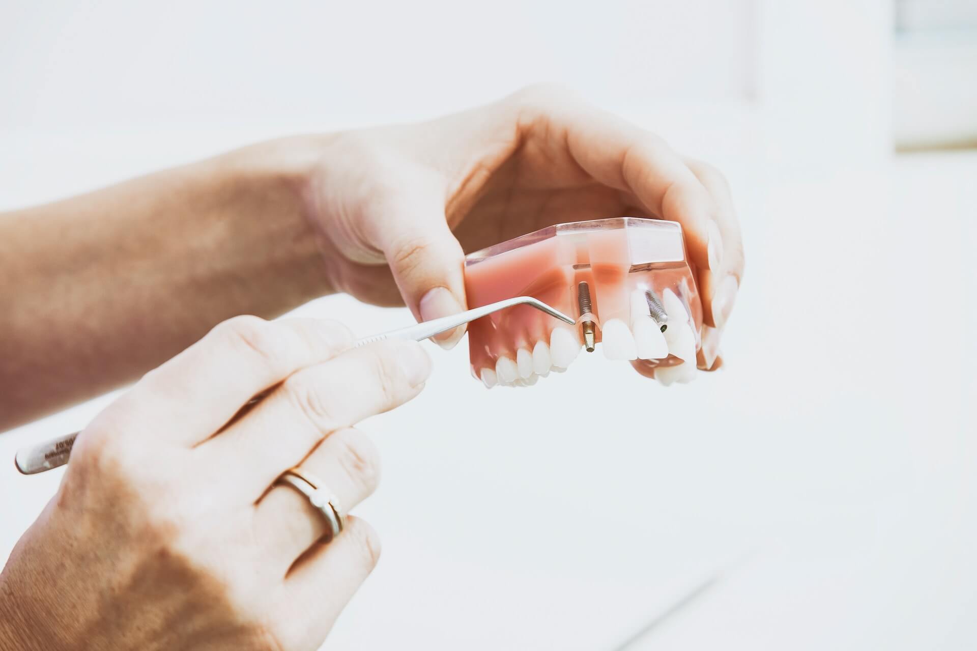 diferencia entre implantes dentales o prótesis removibles